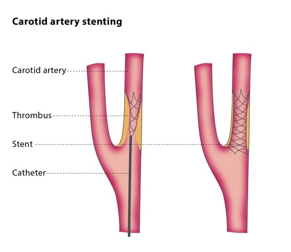 Carotid Artery Stenting Cirse