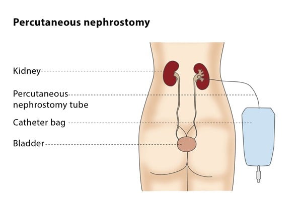 nephrostomy tube