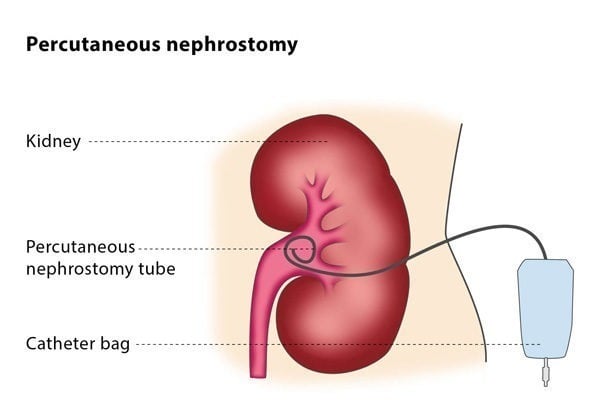 percutaneous nephrostomy