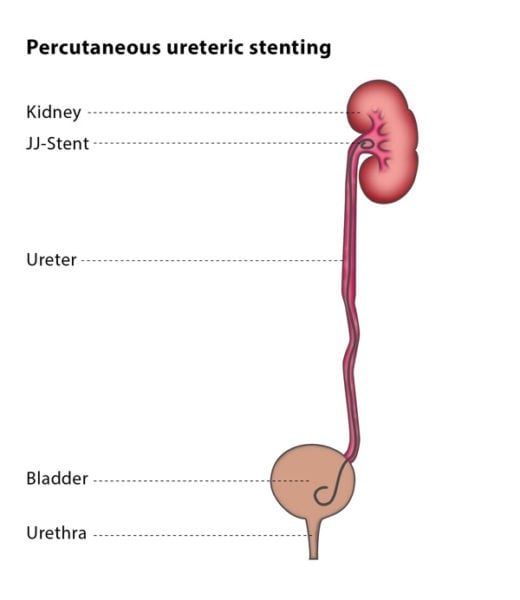 double j ureteral stent