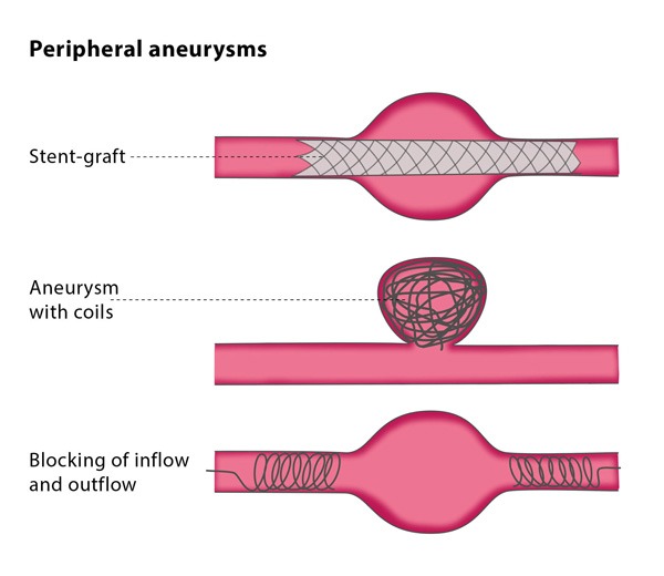 Endovascular Treatment Of Peripheral Aneurysms Cirse