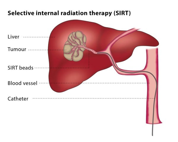 radiation therapy diagram